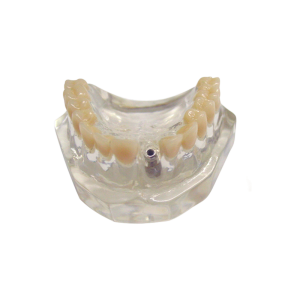 MAXILA ACRÍLICA COM DENTES E 1 IMPLANTE - cód. 4217 A