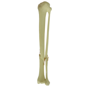 TÍBIA COM CANAL MEDULAR E ESPONSOJO COM FÍBULA - FRATURA 2 - ESQUERDA - cód. 9701